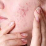Hormonal Acne: Treatment and Causes